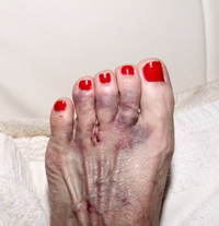 Neuromas are a swollen, benign mass of nerves that occurs between the third and fourth metatarsal. We can help, call 214-574-9255 for Relief.  