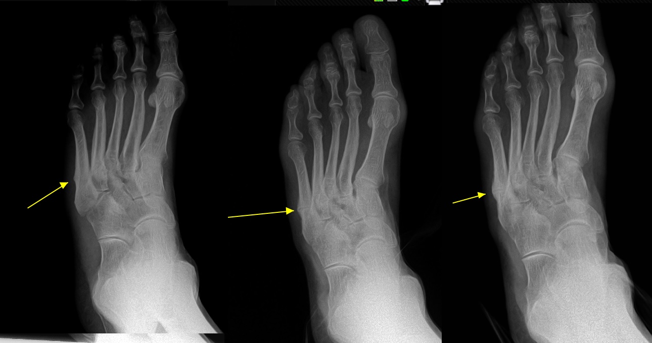 Stress Fractures - North Texas Foot & Ankle